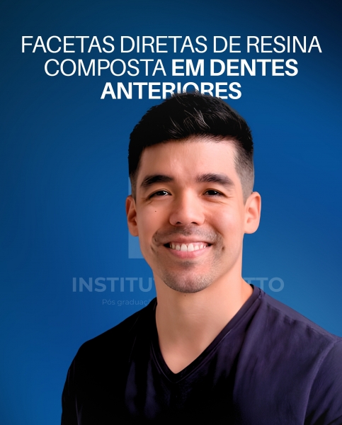 FACETAS DIRETAS DE RESINA COMPOSTA EM DENTES ANTERIORES