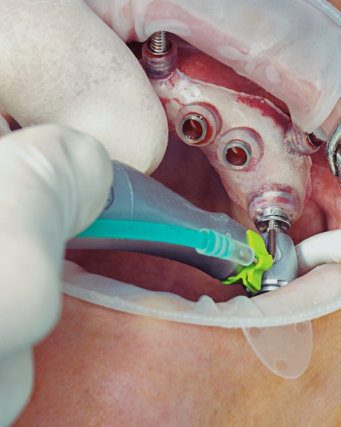 PRATICE ZYGOMA - ALL ON 4 